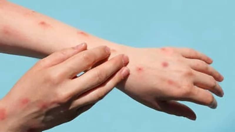 تسجيل أول حالة وفاة بفيروس جدري القرود