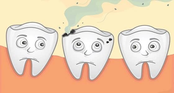 أطباء: تسوس الأسنان قد يؤثر على القلب