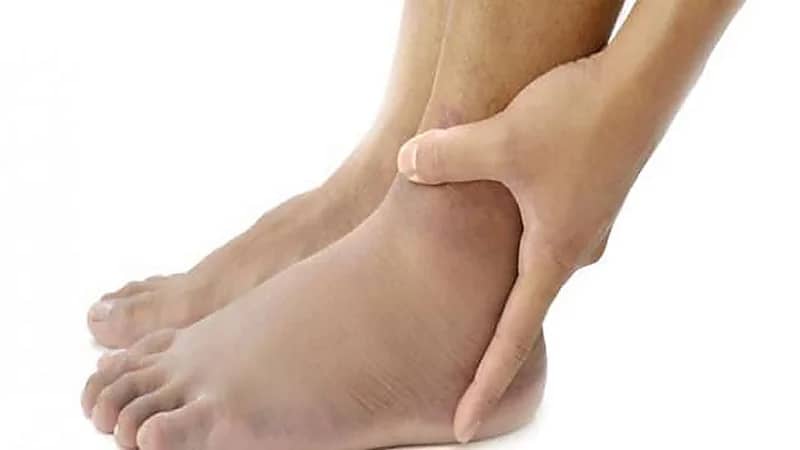 مختص يوضح سبب تورم القدمين