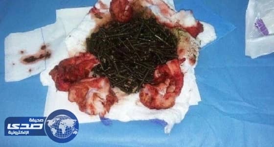 استخراج " مسامير " من معدة مريض بجدة