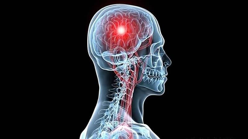 أبرز الأعراض التي تسبق الجلطة الدماغية