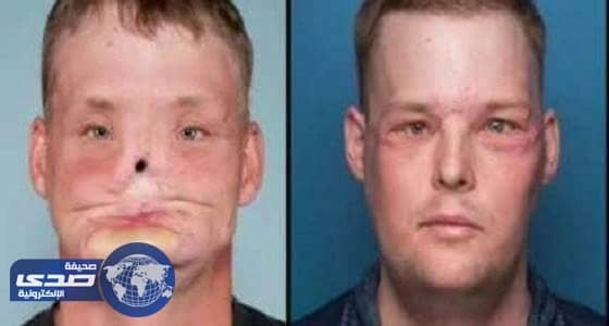 فجر شاب رأسه لكن حدثت معجزة