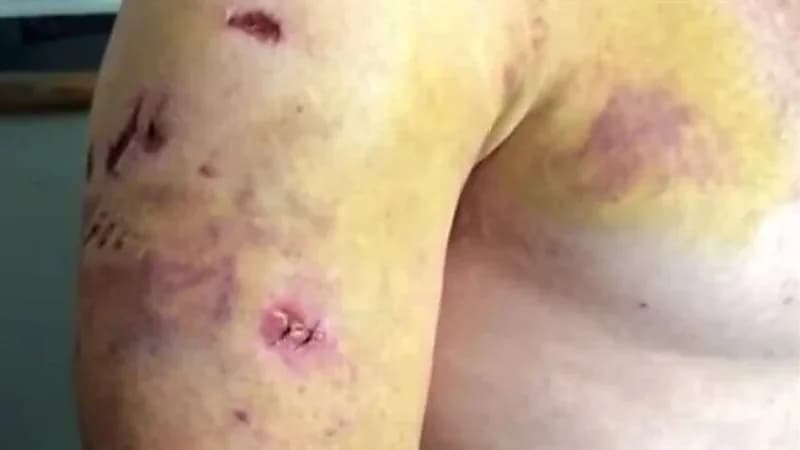 بالصور.. صياد يتعرض لـ 25 عضة من دب شرس