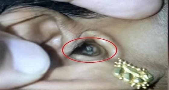 بالفيديو.. طبيب يعثر على عنكبوت حي يتحرك داخل أذن سيدة