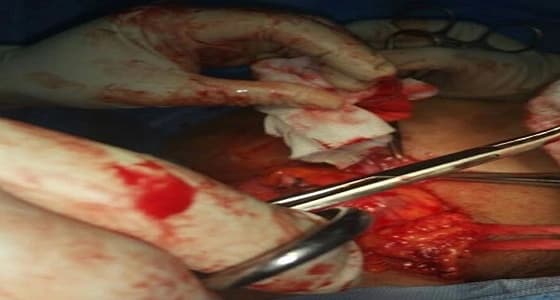 استئصال ورم من مريضا بمستشفى عيون الجواء
