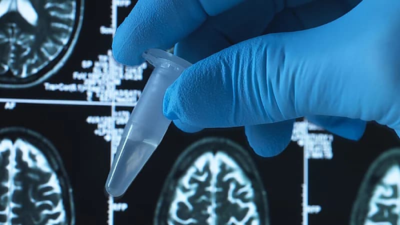 علماء يكتشفون أن الإصابة بـ" الزهايمر" قد تنتج عن اضطرابات في الكبد