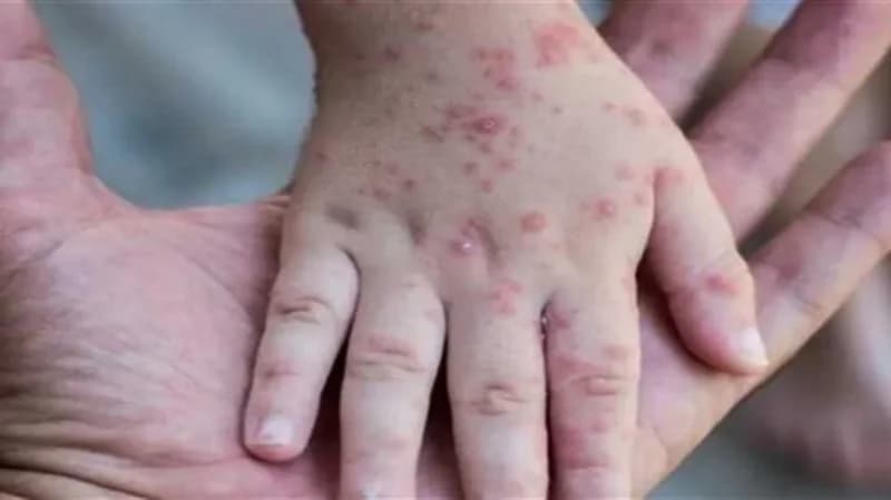 دراسة: جدري القرود يؤدي لعواقب عصبية ونفسية