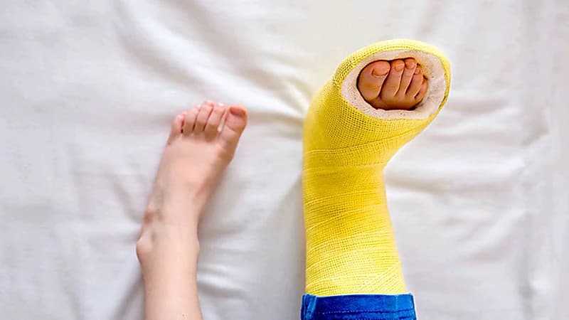 5 خطوات لتجنب تحول الكسور البسيطة إلى مضاعفة