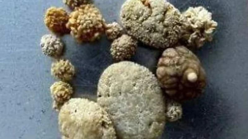 مخرج يعتبر حصوات كليته عملاً فنيًا ويعرضها للبيع