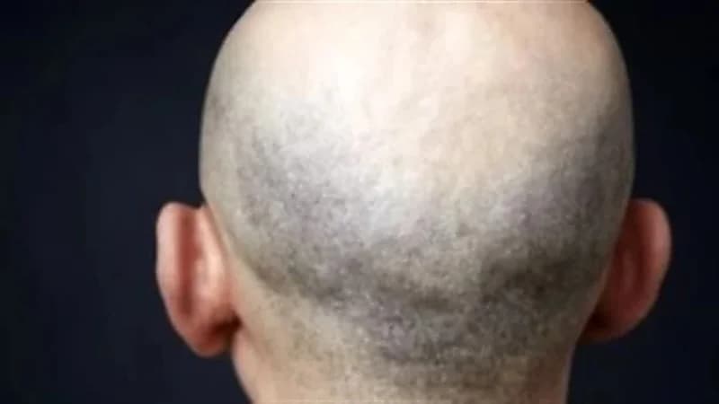 محكمة تعوض موظف بسبب طرده من وظيفته لأنه "أصلع"