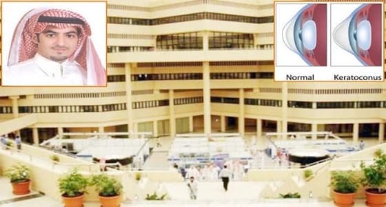 استشاري بجامعة القصيم  : فرك  العين والعدسات تحدّب قرنيّة العين