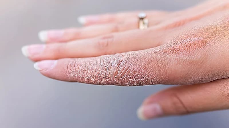 بالفيديو .. علامات تنذر بنقص الزنك في الجسم