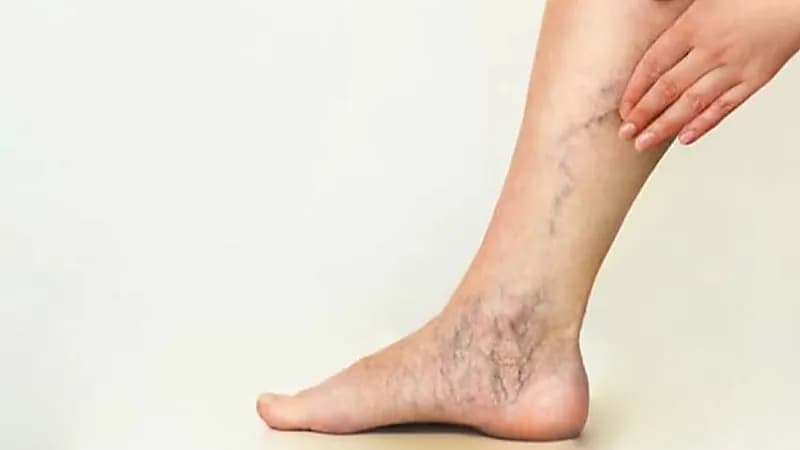 4 نصائح مهمة للتخلص من الدوالي دون تدخل جراحي