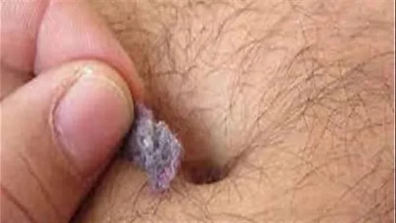 سبب غير متوقع لوجود قطن في سرة البطن