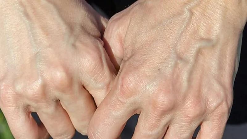 أسباب ظهور الأوردة بشكل بارز لدى البعض