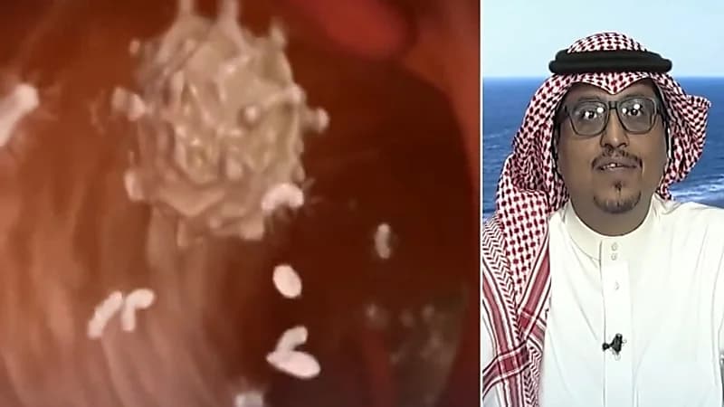 بالفيديو.. استشاري: جرثومة المعدة تنتقل من شخص لآخر بواسطة الأكل والماء الملوث