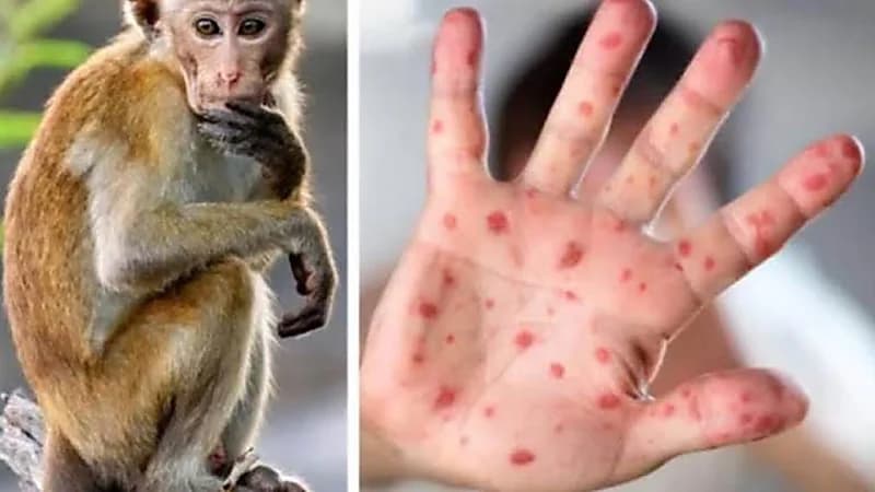 تسجل أول إصابة بجدري القرود في البحرين