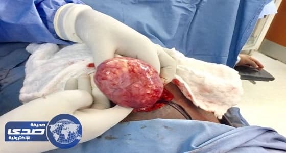 فريق طبي ينجح في استئصال ورم بالرحم لطبيبة بمستشفى السليل