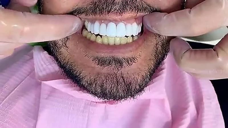 طبيب أسنان: العدسات البيضاء مو بورق جدران وصاحبها سيعاني طوال العمر .. فيديو