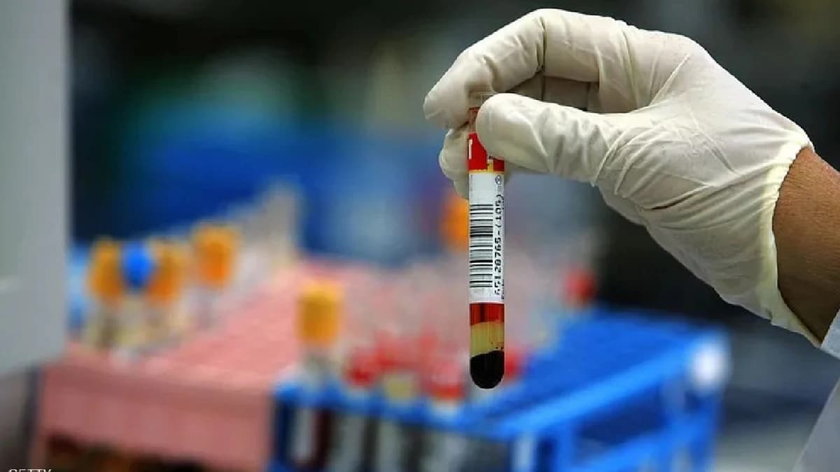 باحثون يكتشفون اختبار دم يتنبأ بخطر الإصابة بأمراض الكبد