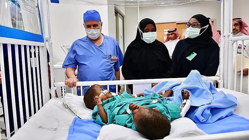 رئيس الفريق الطبي للتؤام السيامي التنزاني: سنبدأ في المرحلة السادسة من الفصل.. فيديو