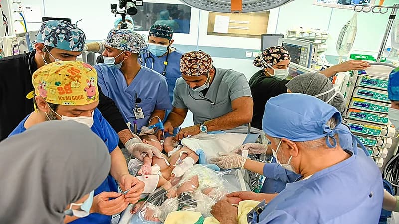 بالفيديو .. نجاح فصل التوأم السيامي العراقي "عمر" و"علي" وبدء عملية الترميم