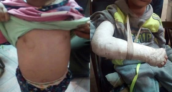 أب يتعدى بالضرب المبرح على طفليه ويصيبهما بكسور وكدمات