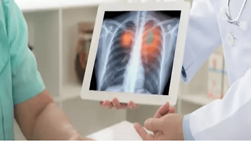 عوامل الخطورة المسببة لسرطان الرئة