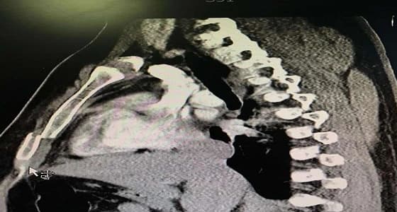 نجاح أول عملية تثبيت للقفص الصدري بمستشفى الملك فهد في الباحة
