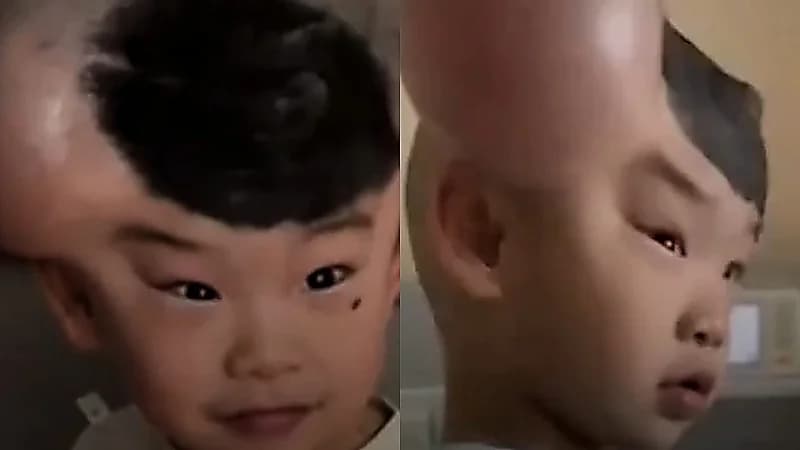 طفل صيني يُلقب بـ ميكي ماوس بسبب وحمتين نادرتين على رأسه .. فيديو