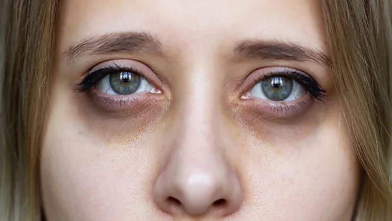 نصائح للتخلص من السواد تحت العين