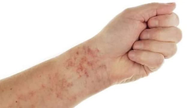 انتشار مرض نادر وأطباء يكشفون أعراضه