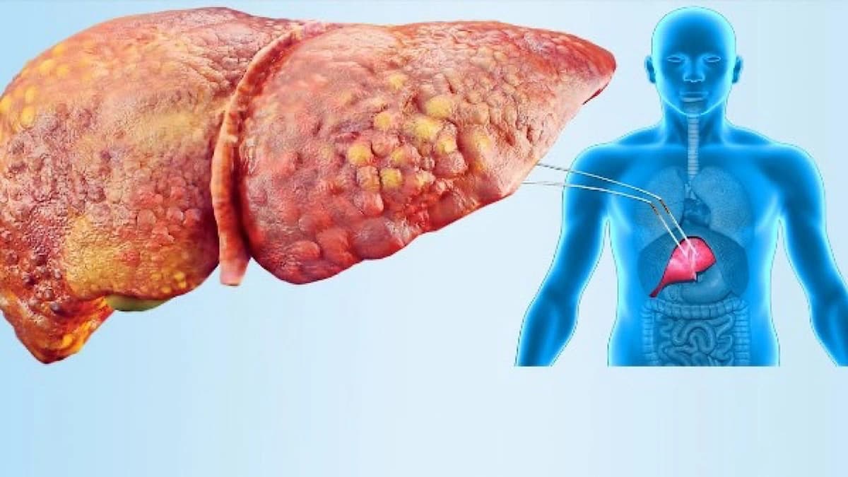 5 علامات  تنذر بإصابتك بالكبد الدهني