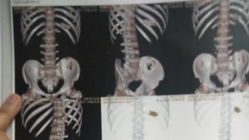 شاب يبتلع هاتفه المحمول 3 أشهر