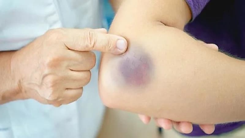 البقع الزرقاء على الجسم من أعراض أمراض الكبد