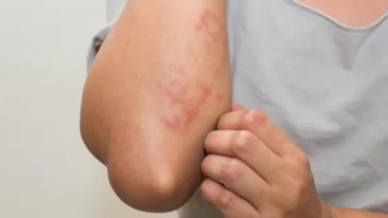 "وقاية" تقدم عدة نصائح للوقاية من جدري القرود