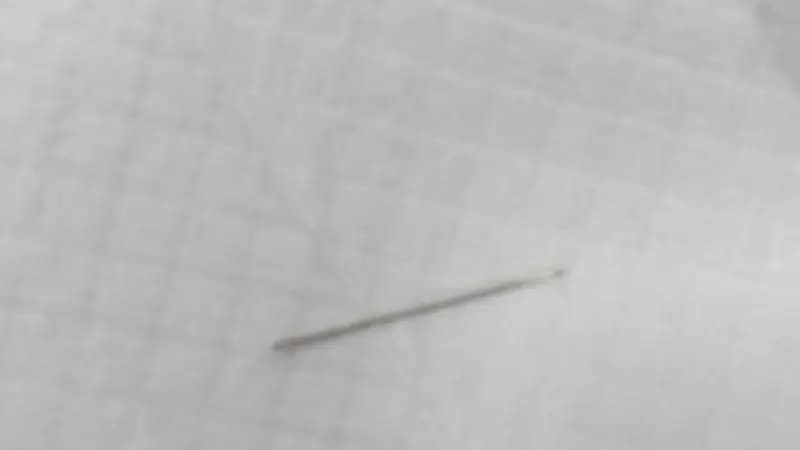 "فريق طبي" ينجح باستخراج إبرة خياطة من بطن مريضة بتخصصي بريدة