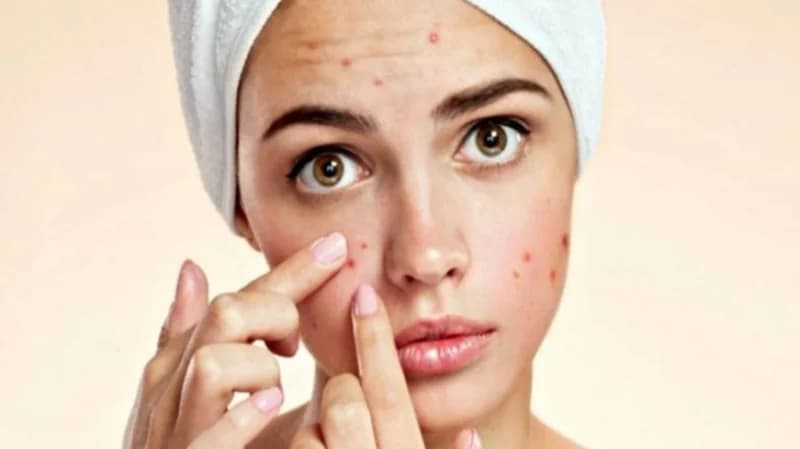 خطوات تساعدك للتخلص من حبوب الوجه قبل الزفاف