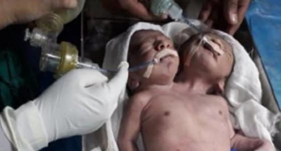 ولادة نادرة لتوأم ملتصق برأسين وجسد واحد في الهند