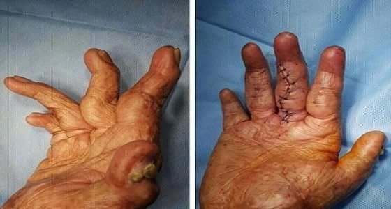 إنهاء معاناة شاب عشريني بإعادة أصابعه لطبيعتها بمستشفى دومة الجندل