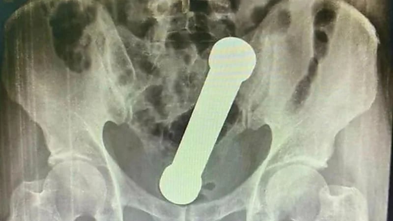 دخول دمبل في جسم مسن وإنقاذه بصعوبة