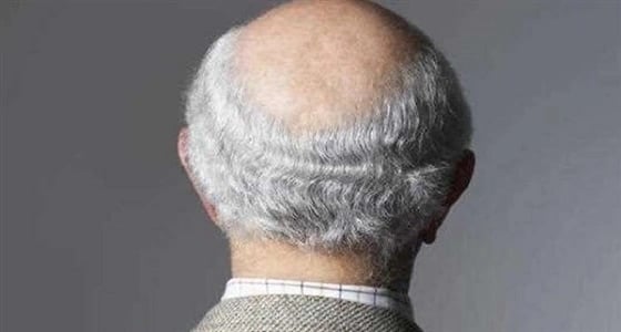 دراسات تكشف أسبابا غير متوقعة للصلع والشيب