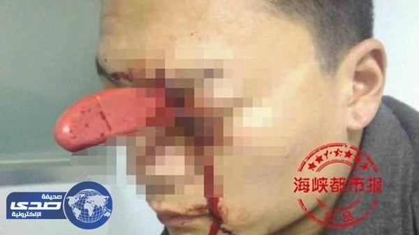 بالصور.. صينية تغرس سكيناُ بعين زوجها بسبب خلافات بينهما