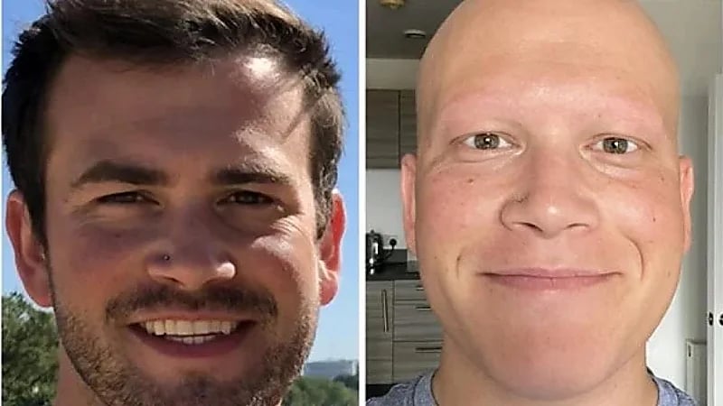 شاب يفقد 100% من شعر رأسه وجسده بشكل مرّوع