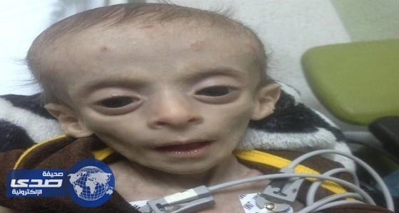 بالصور.. مرض نادر يجبر الأطباء على فتح بطن طفل لتزويده بالطعام