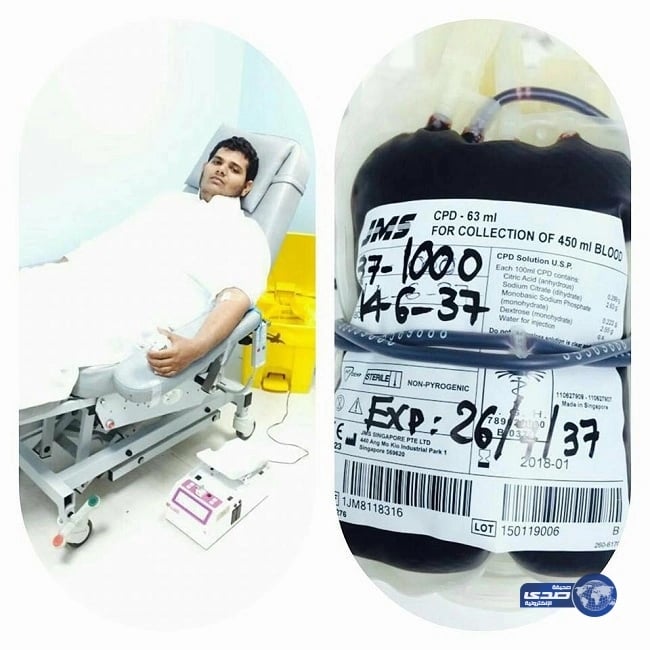 فريق طبي يعالج «الحول» بدون جراحة في الطائف