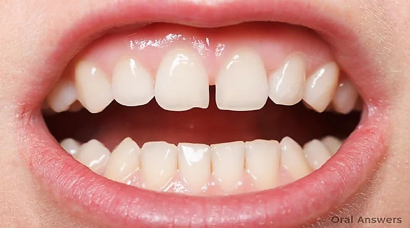 أخصائي يكشف عن علامات تستدعي زيارة الطبيب فورا حال ظهورها على أسنان الطفل "فيديو"