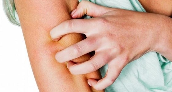 اكتشاف حالة مصابة بـ " الجرب " بإحدى المدارس في حائل