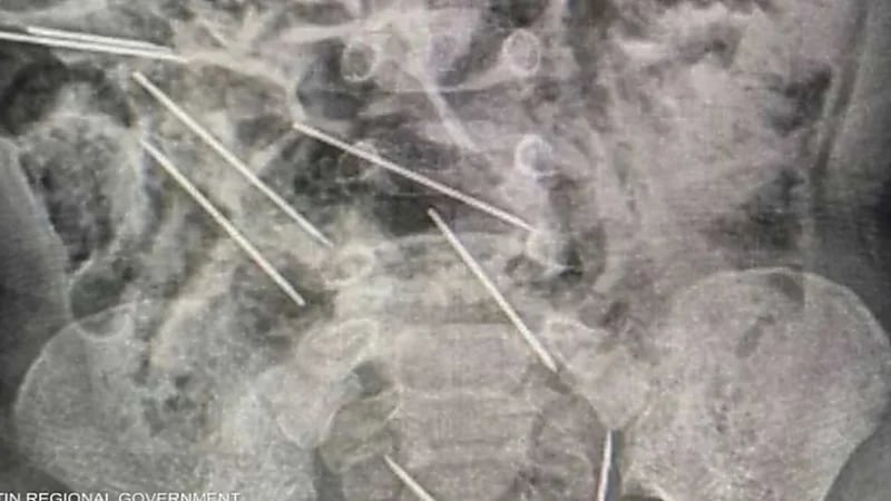 طفل يبتلع 8 إبر حقن مخصصة للحيوانات