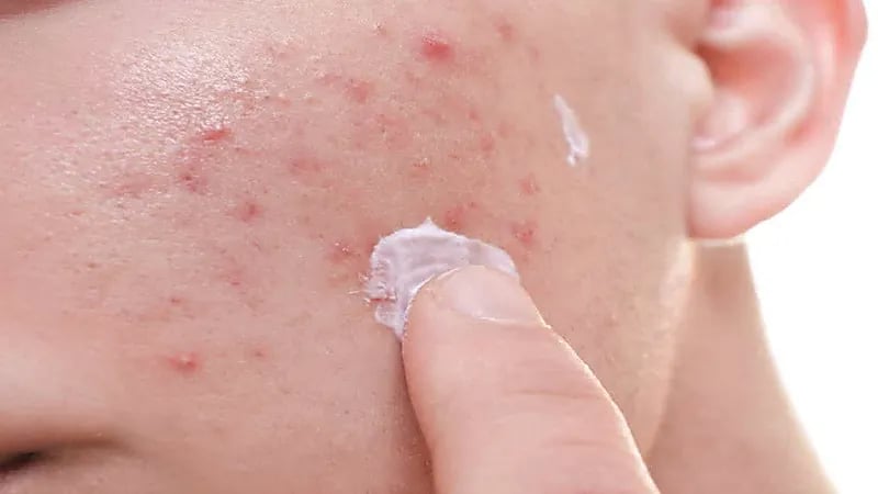 الإجهاد النفسي يؤدي إلى تساقط الشعر وظهور حب الشباب